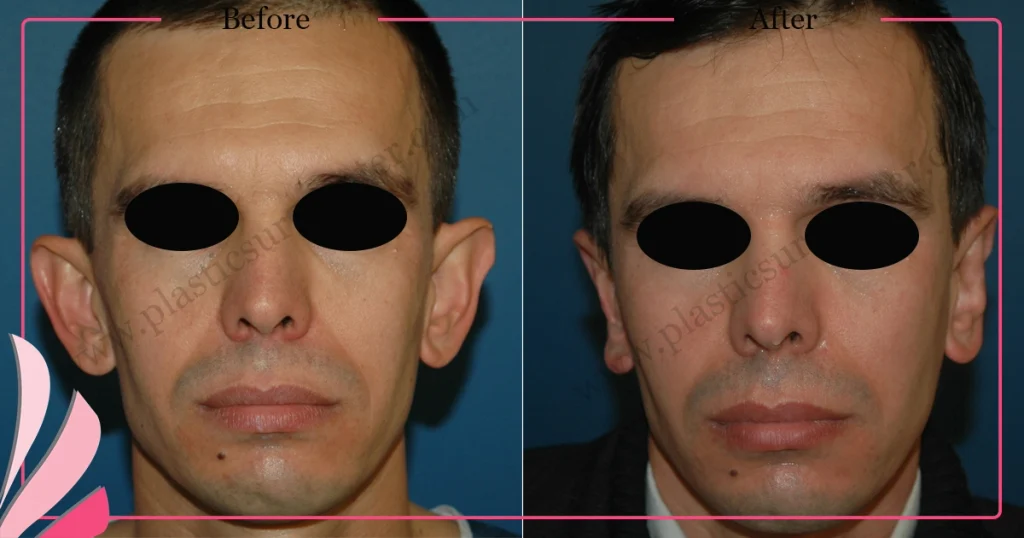 Otoplasty, Prominent ear surgery - Case 10 - Front View