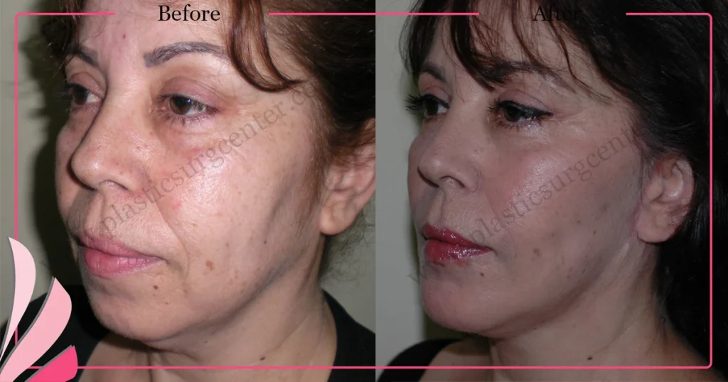 Facelift before and after - Case 18, Left Oblique view