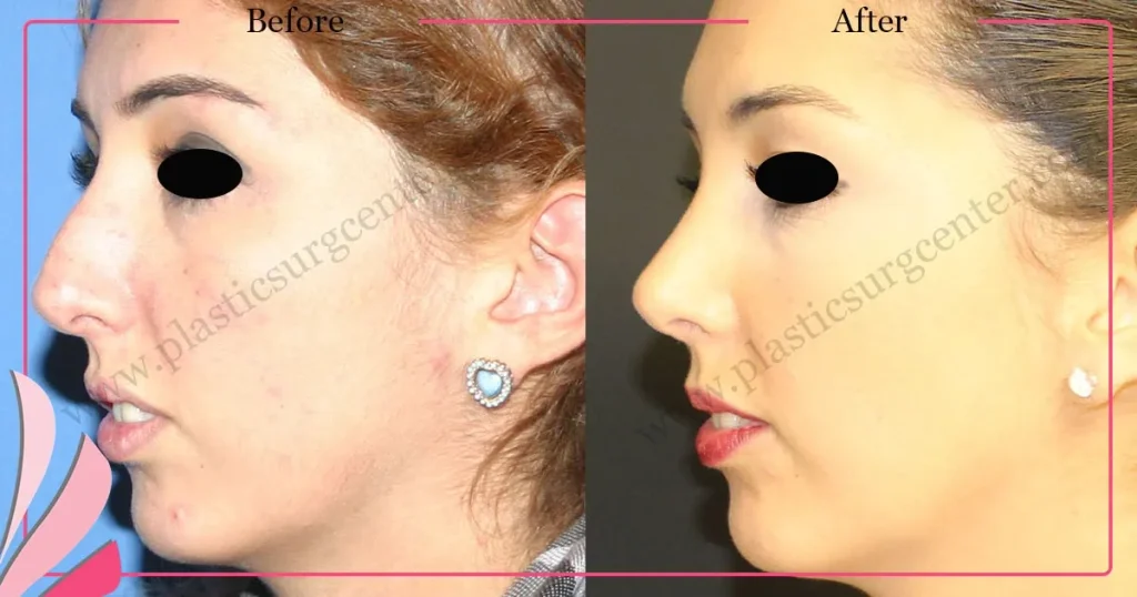Rhinoplasty in Turkey - Case 29 - Female - Left Profile