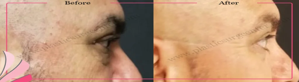Lower eyelid surgery - case 23 - Right profile