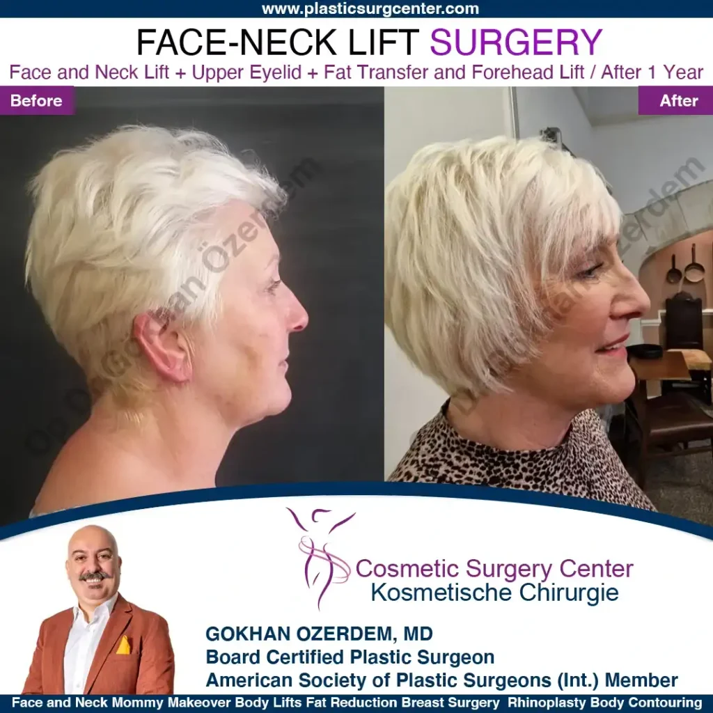 Facelift before and after - Case 3, Right Profile