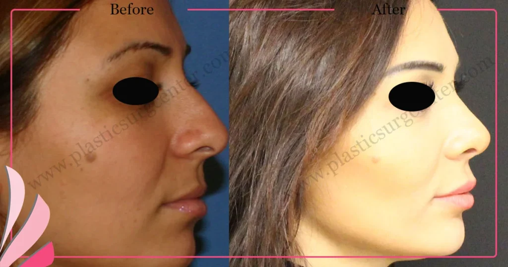Rhinoplasty in Turkey - Case 31 - Female - Right Profile