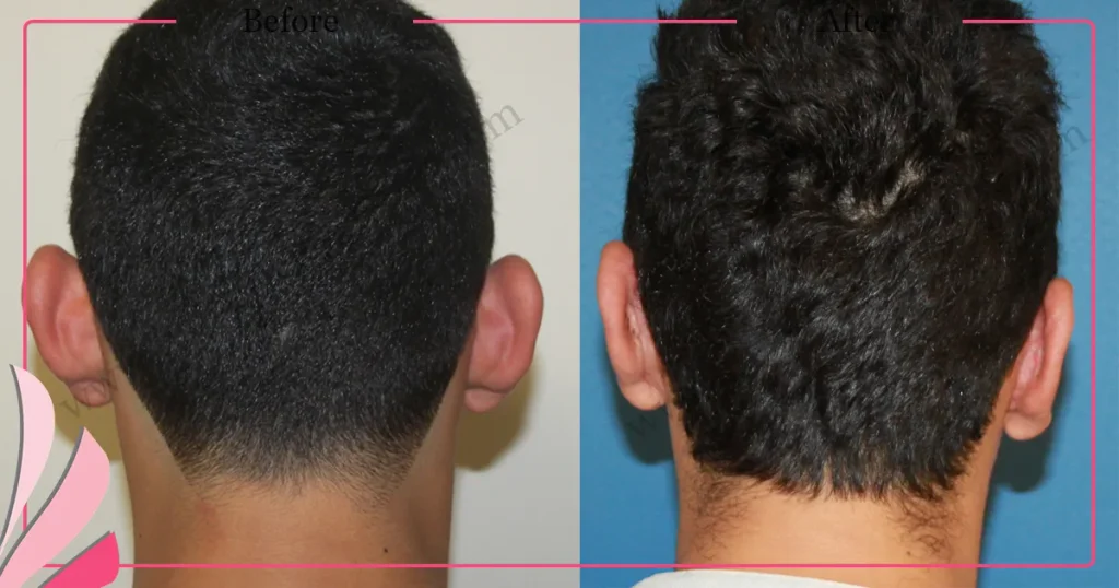 Otoplasty in Turkey, Antalya Prominent ear surgery - Case 3 - Back View