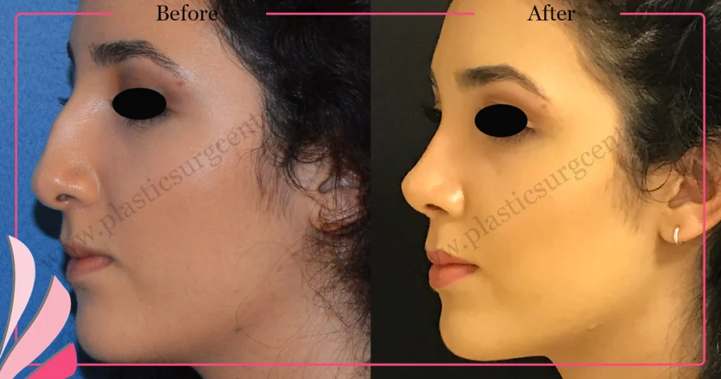 Rhinoplasty in Turkey - Case 32 - Female - Left Profile