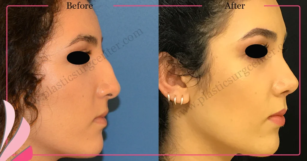Rhinoplasty in Turkey - Case 32 - Female - Right Profile