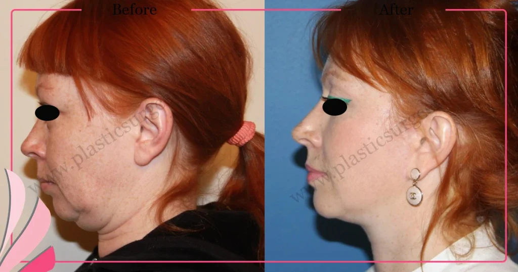 Facelift before and after - Case 19, Left Profile