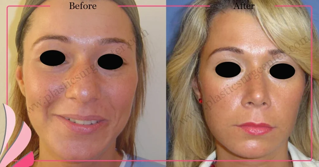 Rhinoplasty in Turkey - Case 24 - Female - Front View
