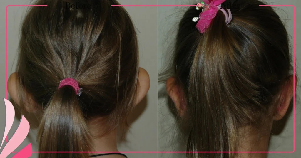 Otoplasty, Prominent ear surgery - Case 1 - Back View