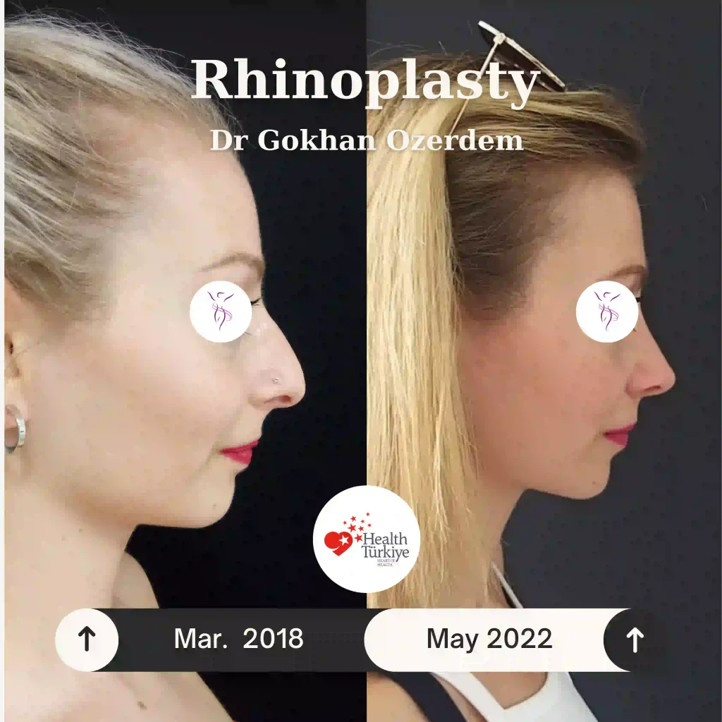 Rhinoplasty in Turkey - Case 7 - Female - Right Profile