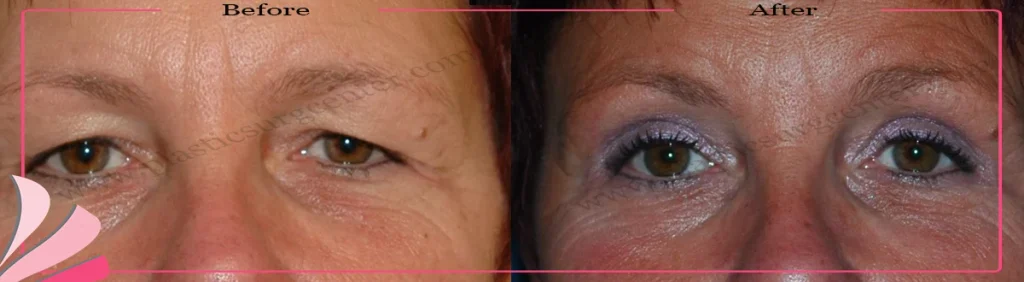 Upper eyelid surgery - case 35 - Front view