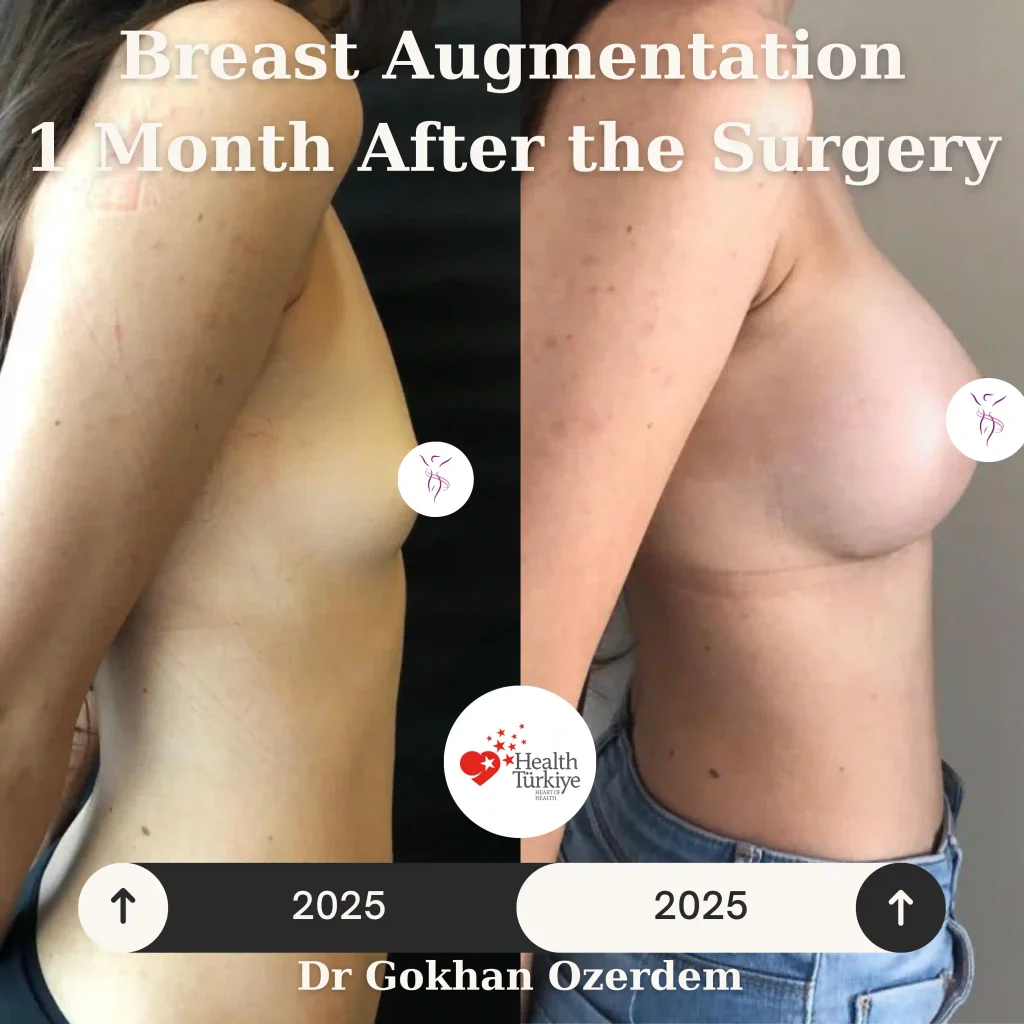 Breast Augmentation in Turkey - Case 57 - Right Side