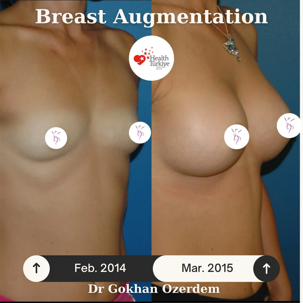 Breast Augmentation in Turkey - Case 54 - Oblique View