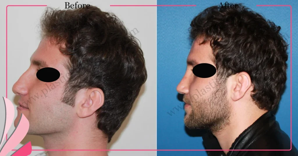 Rhinoplasty in Turkey - Case 30 - Male - Left Profile