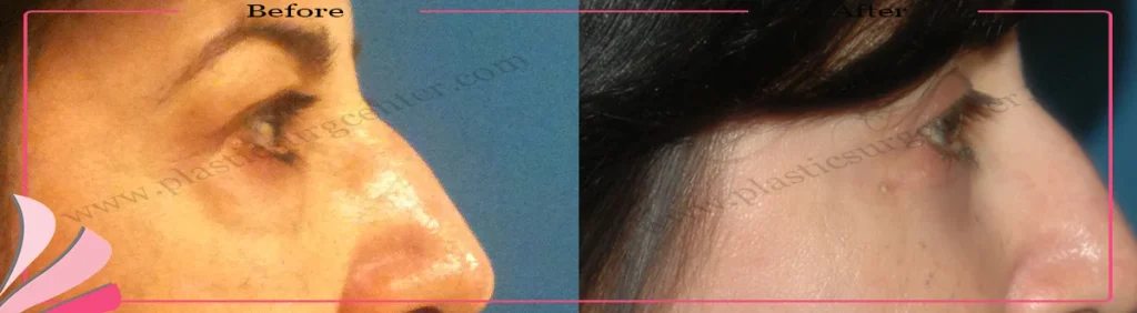 Lower eyelid surgery - case 30 - Right Profile