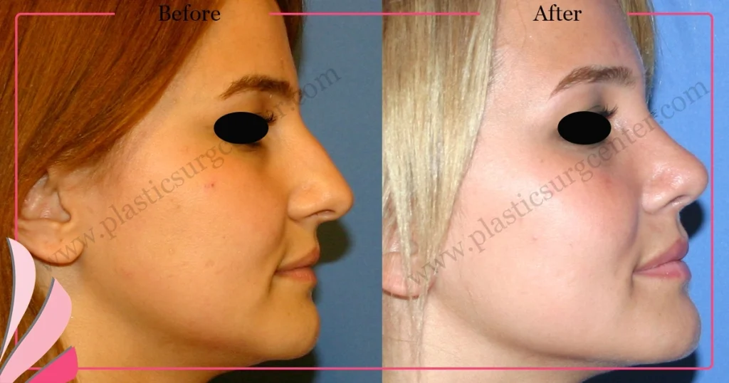 Rhinoplasty in Turkey - Case 22 - Female - Right Profile