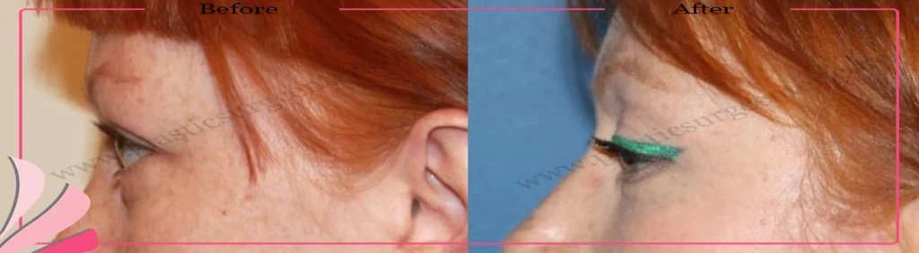 Upper eyelid surgery - case 27 - Right Profile