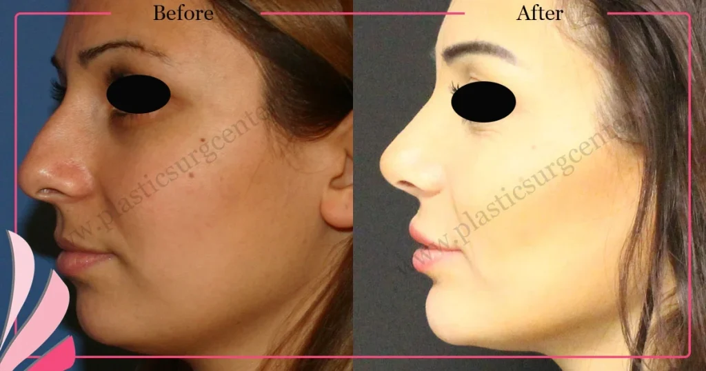 Rhinoplasty in Turkey - Case 31 - Female -Left Profile