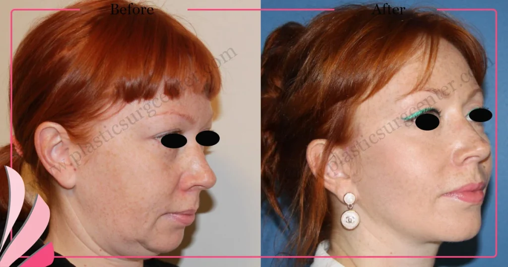Facelift before and after - Case 19, Oblique view