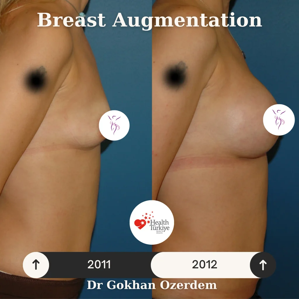 Breast Augmentation in Turkey - Case 51 - Right View