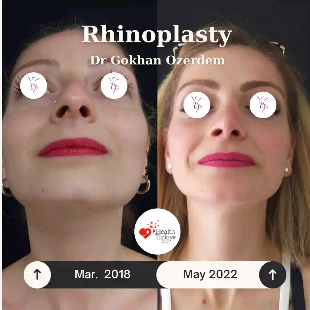 Rhinoplasty in Turkey - Case 7 - Female - Base view