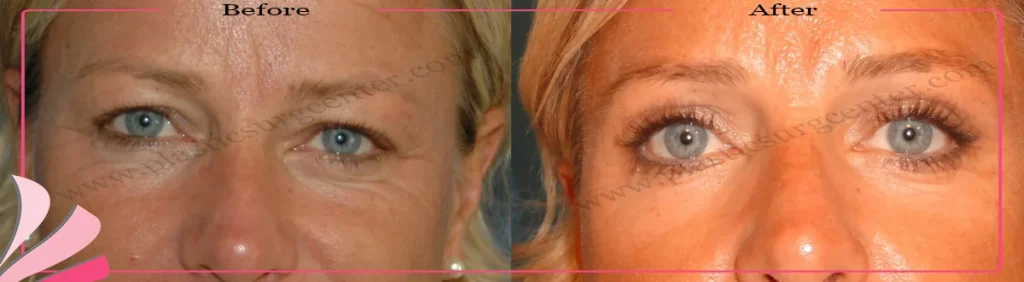 Upper eyelid surgery - case 20 - Front view