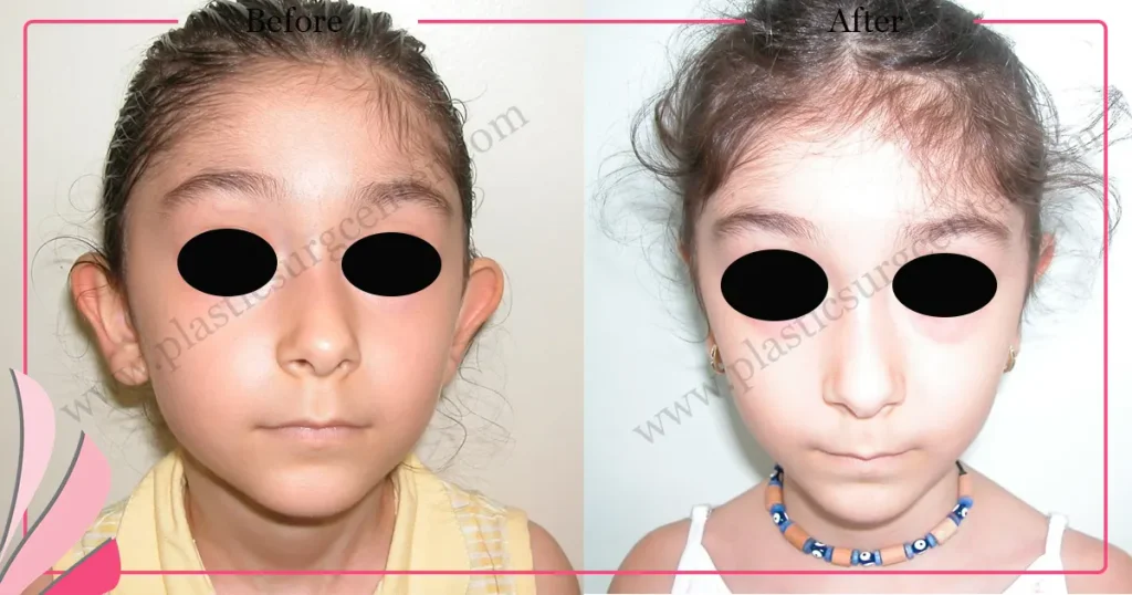Otoplasty, Prominent ear surgery - Case 12 - Front View