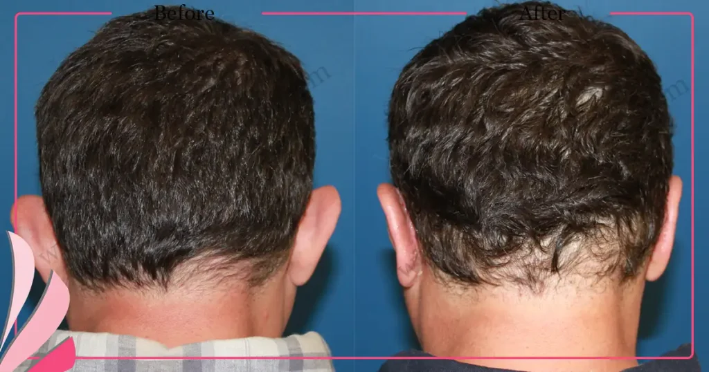 Otoplasty, Prominent ear surgery - Case 4 - Back View