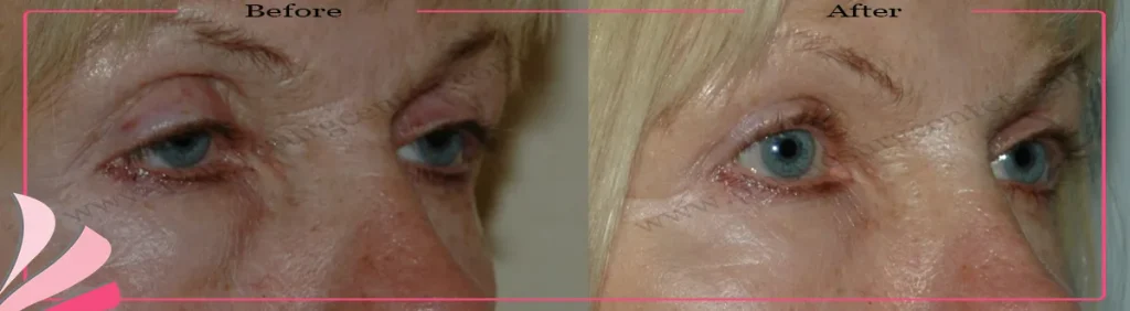 Upper eyelid surgery - case 28 - oblique view