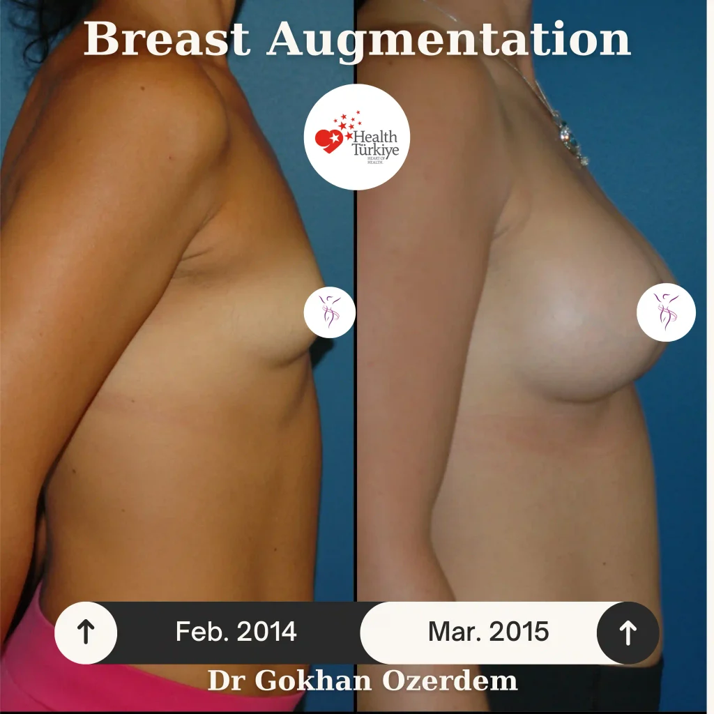 Breast Augmentation in Turkey - Case 54 - Right Side