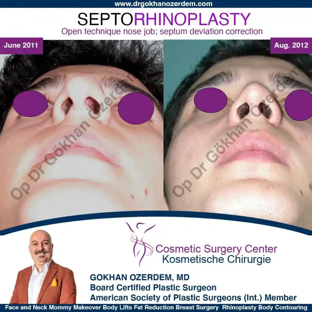 Rhinoplasty in Turkey - Case 6 - Male - Base View