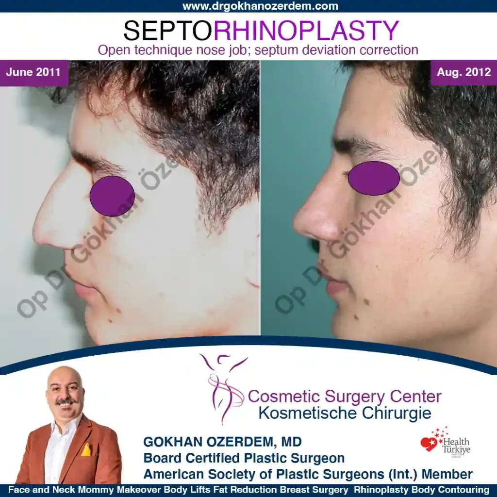 Rhinoplasty in Turkey - Case 6 - male - Right Profile