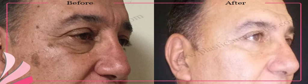 Upper and lower eyelid surgery - case 21 - Oblique view