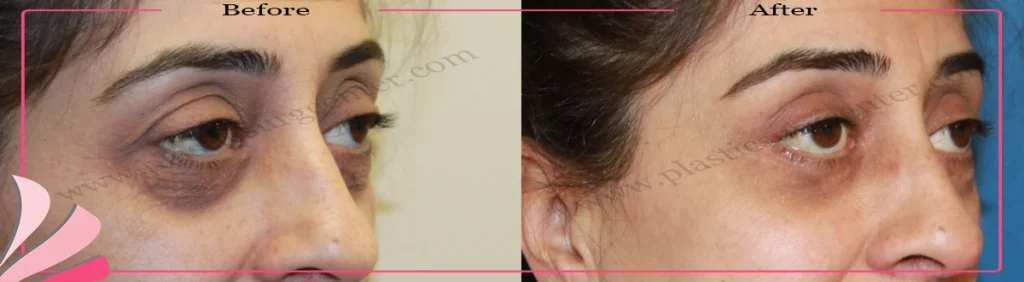 Upper Lower eyelid surgery - case 33 - Oblique