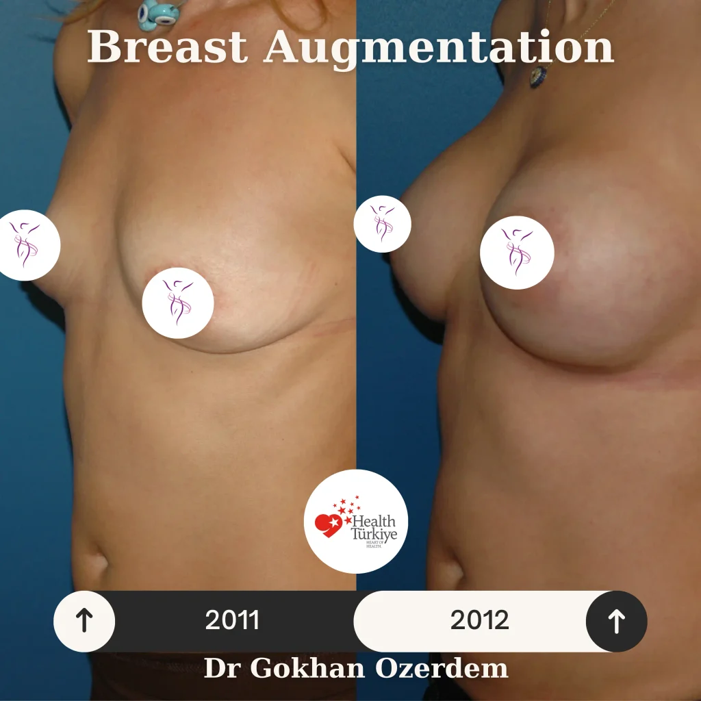 Breast Augmentation in Turkey - Case 51 - Oblique View