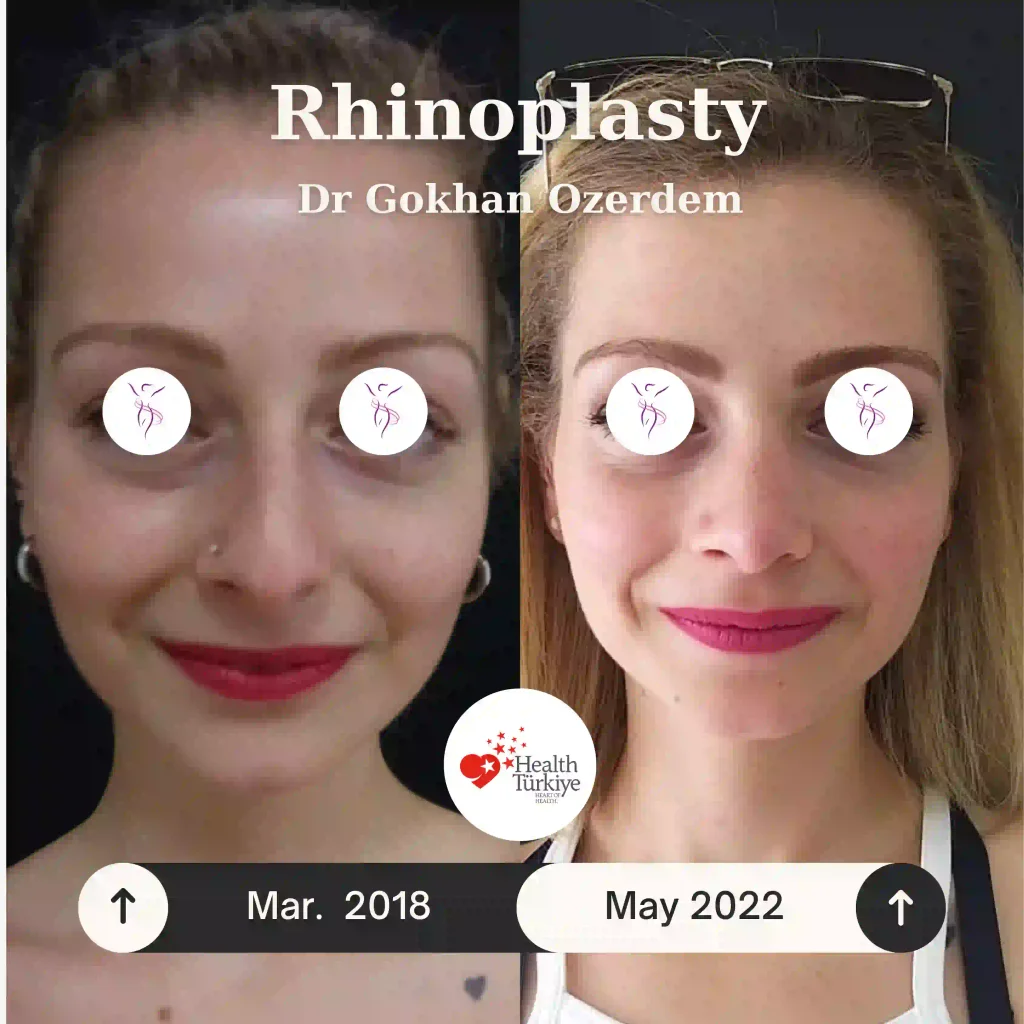 Rhinoplasty in Turkey - Case 7 - Female - Front