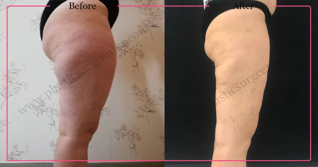 Leg Liposuction in Turkey - Case 3 - Right Side