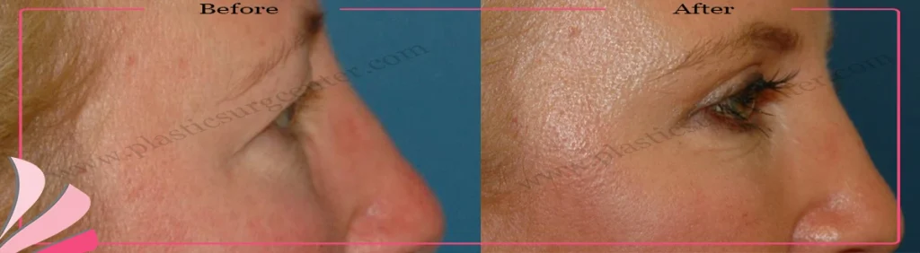 Upper eyelid surgery - case 32 - Right profile