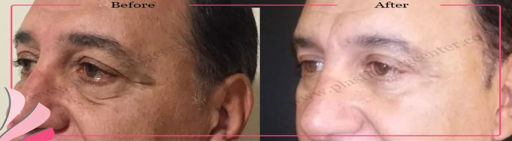 Upper and lower eyelid surgery - case 21 - Left Oblique