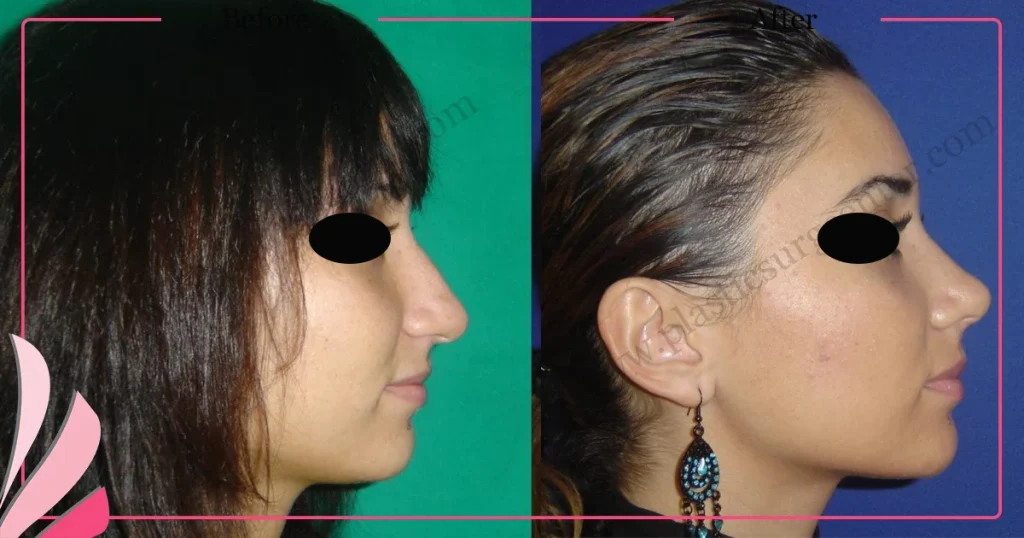 Rhinoplasty in Turkey - Case 23 - Female - Right Profile