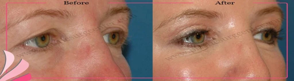Upper eyelid surgery - case 32 - Oblique view