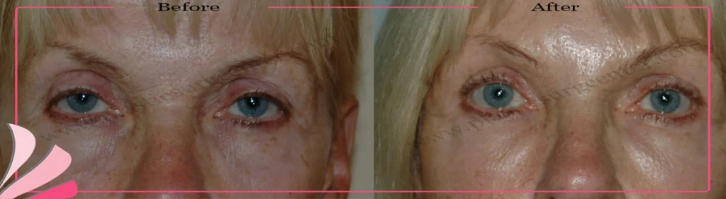 Upper eyelid surgery - case 28 - Front view