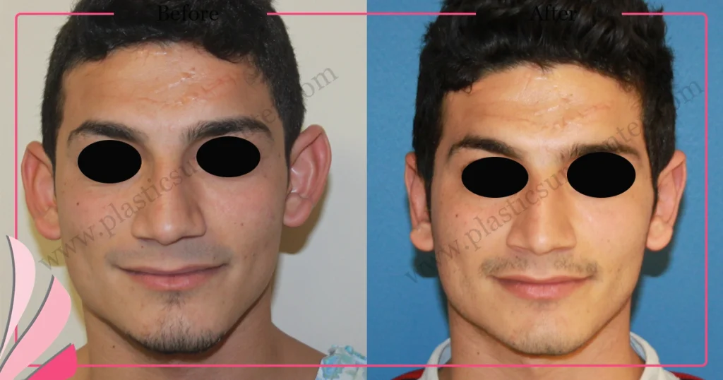 Otoplasty, Prominent ear surgery - Case 3 - Front View