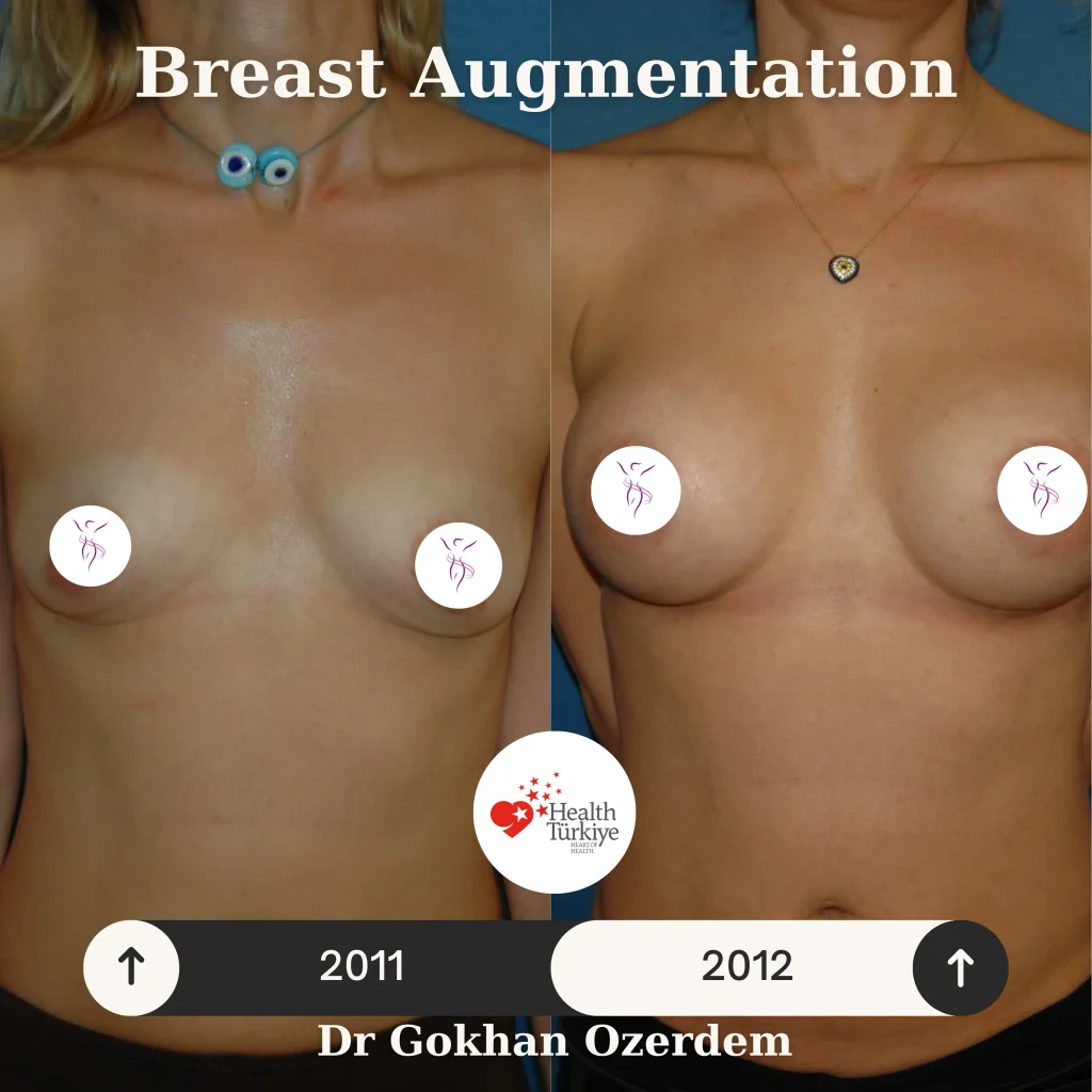Breast Augmentation in Turkey - Case 51 - Front View