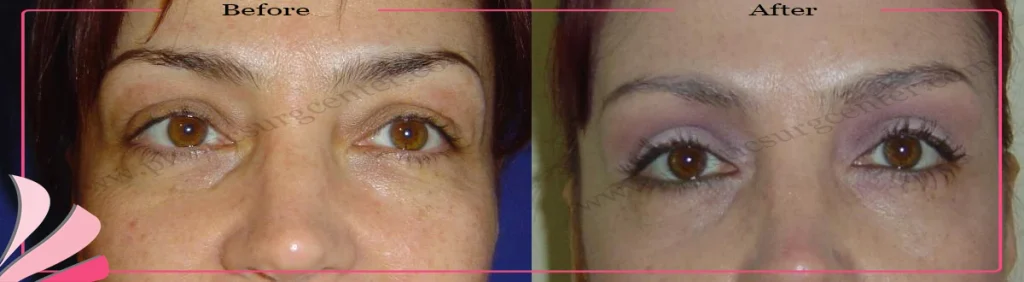 Upper eyelid surgery - case 34 - Front view