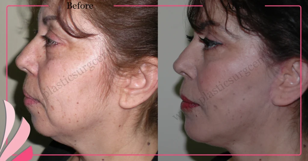 Facelift before and after - Case 18, Left Profile