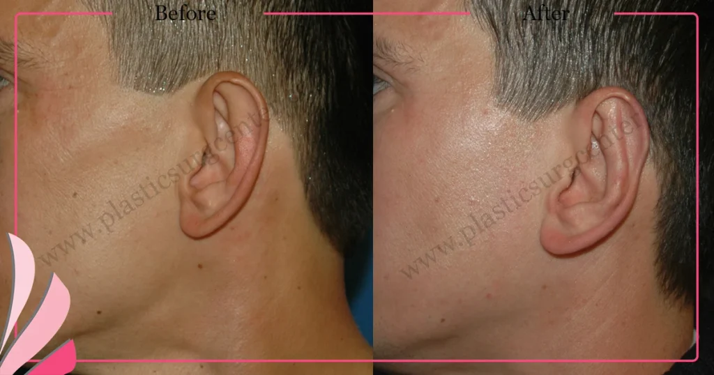 Otoplasty, Prominent ear surgery - Case 2 - Left profile