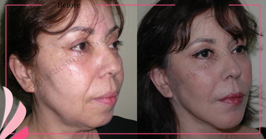 Facelift before and after - Case 18, Oblique view