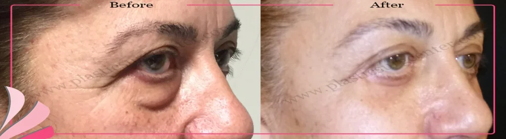 Lower eyelid surgery - case 31 - Oblique view