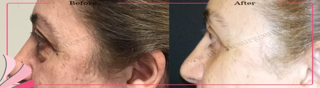 Lower eyelid surgery - case 31 - Left Profile