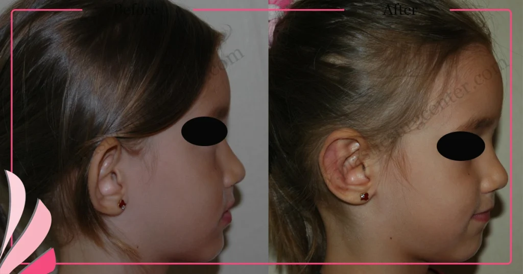 Otoplasty, Prominent ear surgery - Case 1 - Right Profile